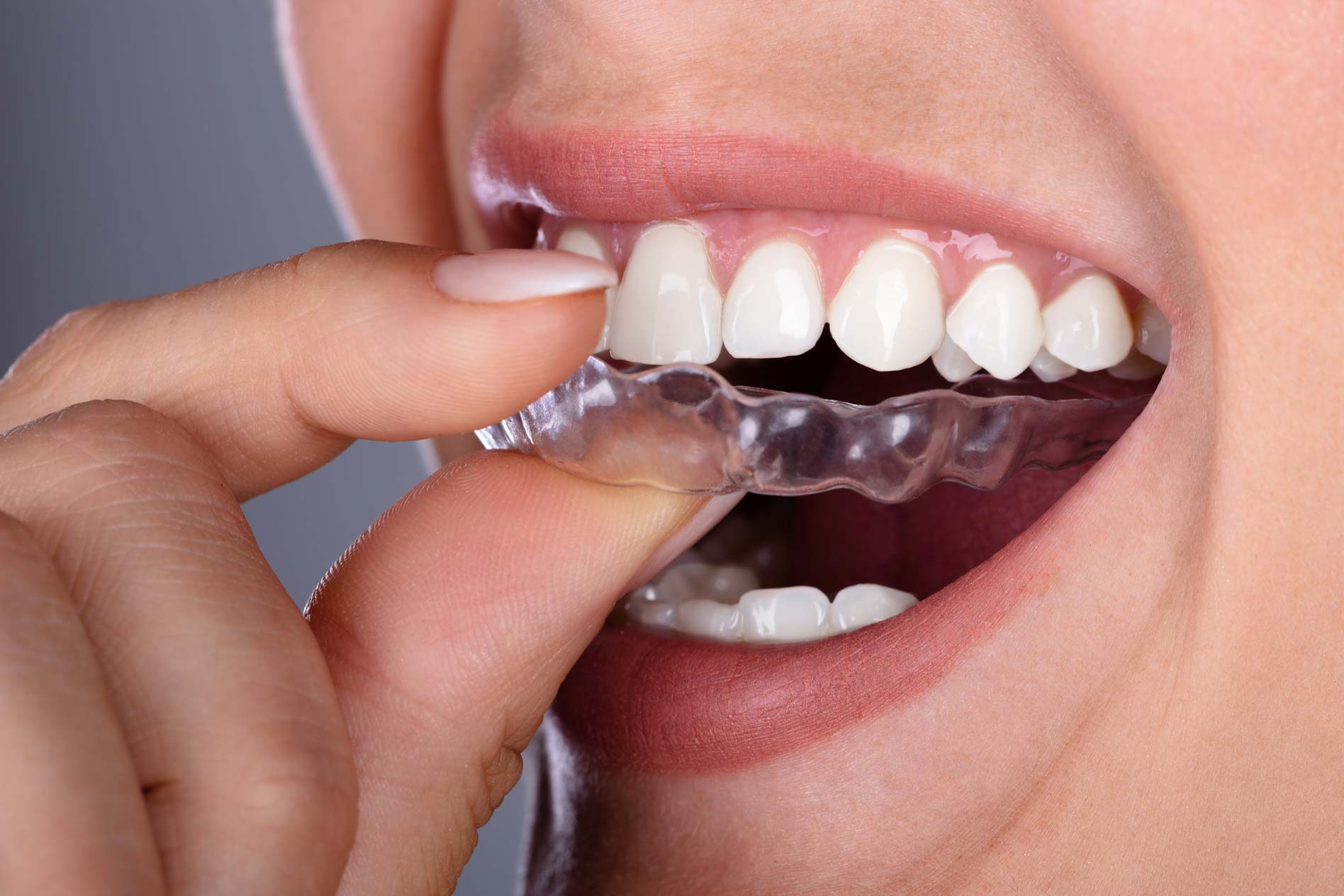 Invisalign - section 1 | Church View Dental Upminster