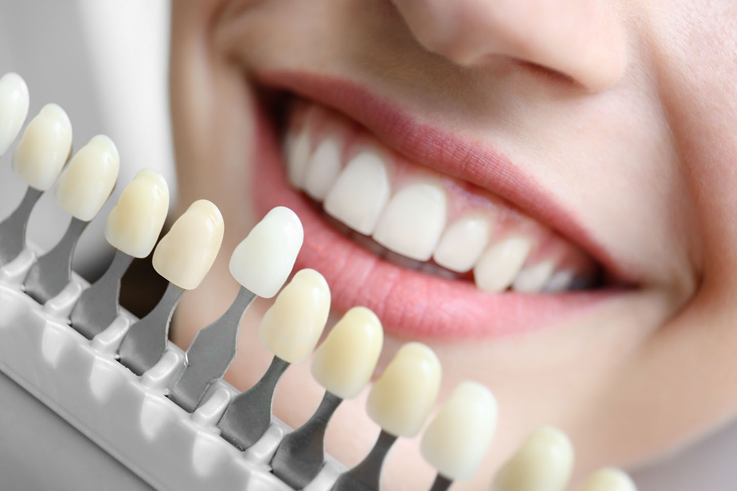 Veneers - section 1 | Church View Dental Upminster