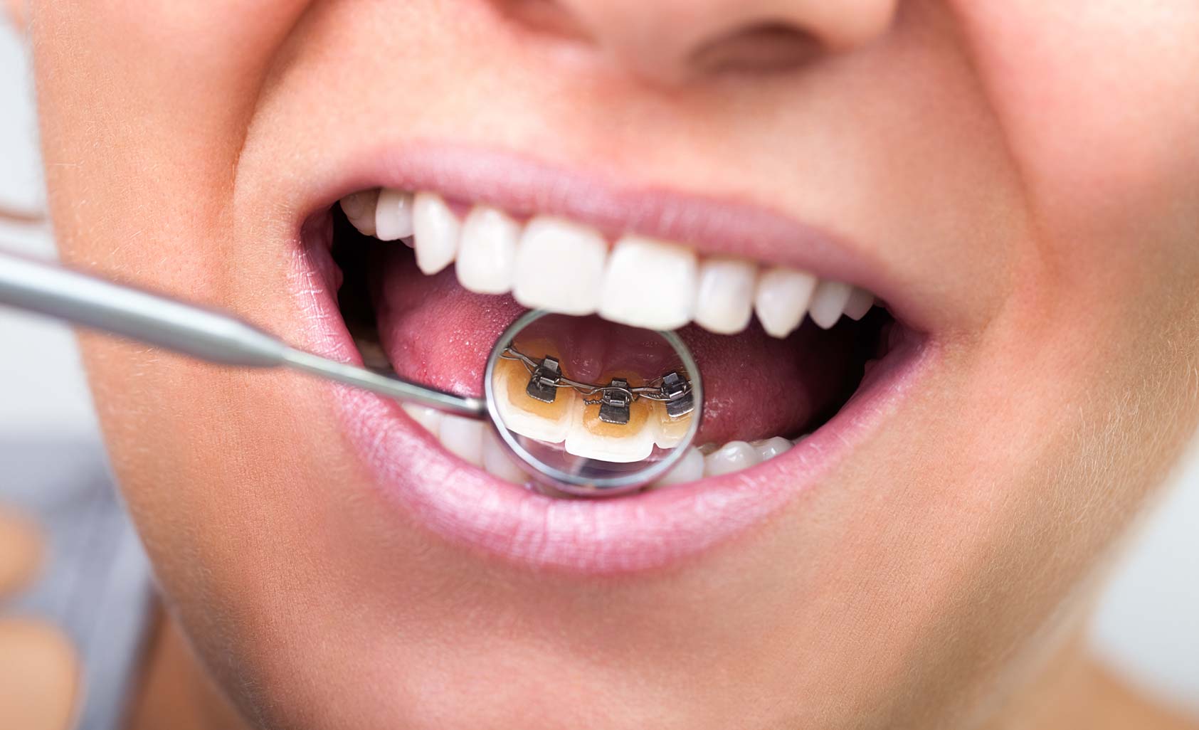 Our orthodontic treatment options at Church View Dental